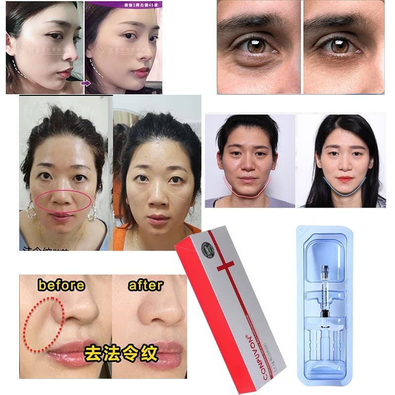 Comwort ácido hialurônico Gel ácido hialurônico grande médio pequeno moléculas Facial pele de maçã templo lábio Na